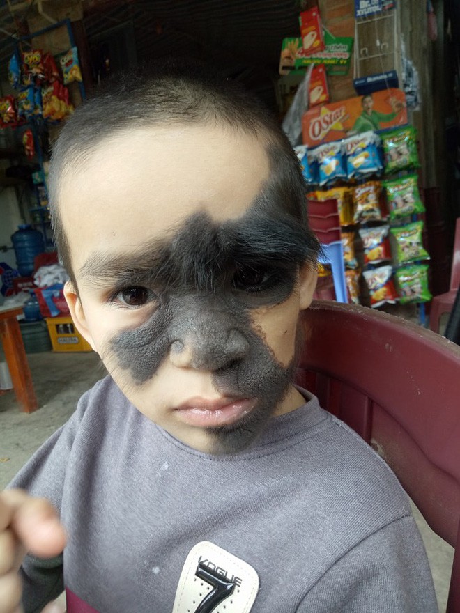 Xót thương bé trai 6 tuổi bị nổi u khắp mặt tựa người rừng từ khi mới chào đời