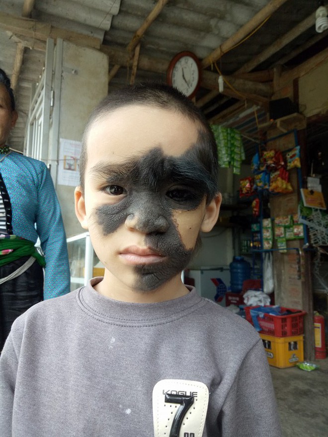 Xót thương bé trai 6 tuổi bị nổi u khắp mặt tựa người rừng từ khi mới chào đời