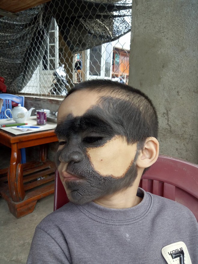 Xót thương bé trai 6 tuổi bị nổi u khắp mặt tựa người rừng từ khi mới chào đời