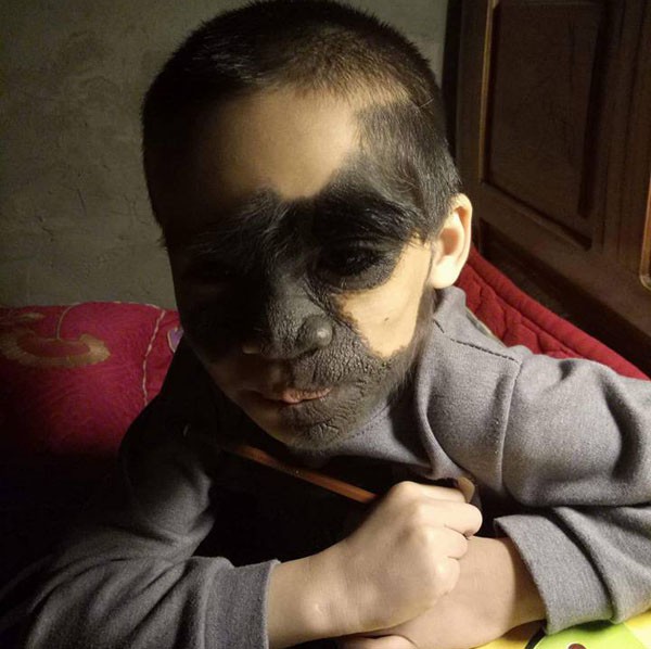 Xót thương bé trai 6 tuổi bị nổi u khắp mặt tựa người rừng từ khi mới chào đời