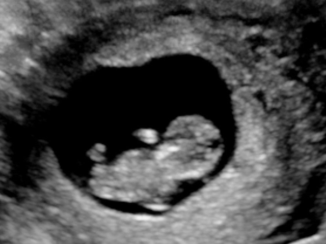 Bà mẹ từng bỏ thai nhưng kết quả siêu âm sau 15 năm khiến bác sĩ rụng rời tay chân