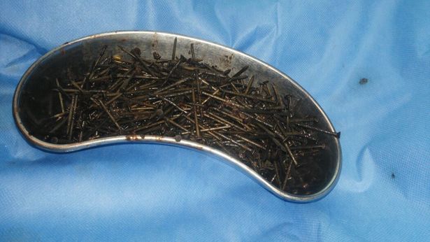 Dùng nam châm hút 600 đinh sắt ra khỏi bụng bệnh nhân