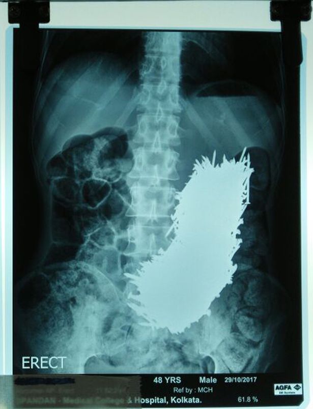 Dùng nam châm hút 600 đinh sắt ra khỏi bụng bệnh nhân