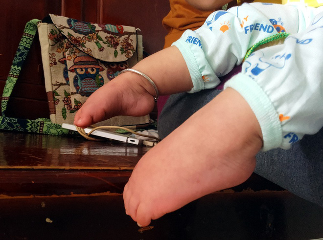 Xót thương bé gái hơn 1 tuổi bị côn trùng đốt khiến tay chân co quắp, teo não không thể nhận thức