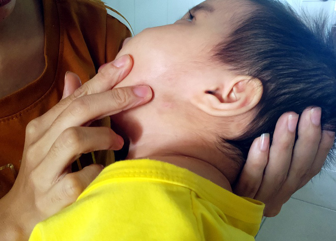 Xót thương bé gái hơn 1 tuổi bị côn trùng đốt khiến tay chân co quắp, teo não không thể nhận thức