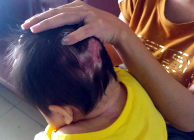 Xót thương bé gái hơn 1 tuổi bị côn trùng đốt khiến tay chân co quắp, teo não không thể nhận thức