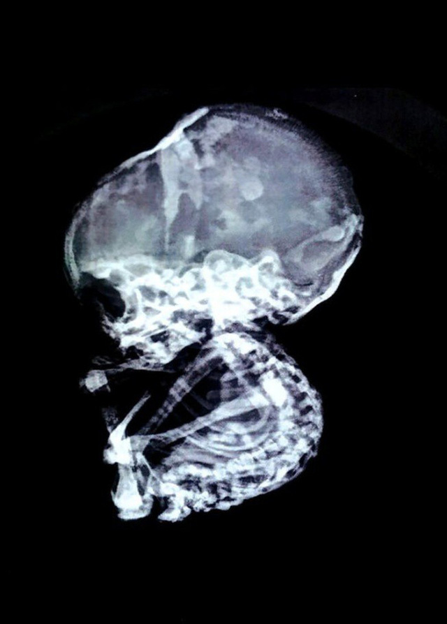 15 năm sau khi nạo thai, sốc vì bào thai vẫn còn nguyên trong bụng mẹ, hóa đá