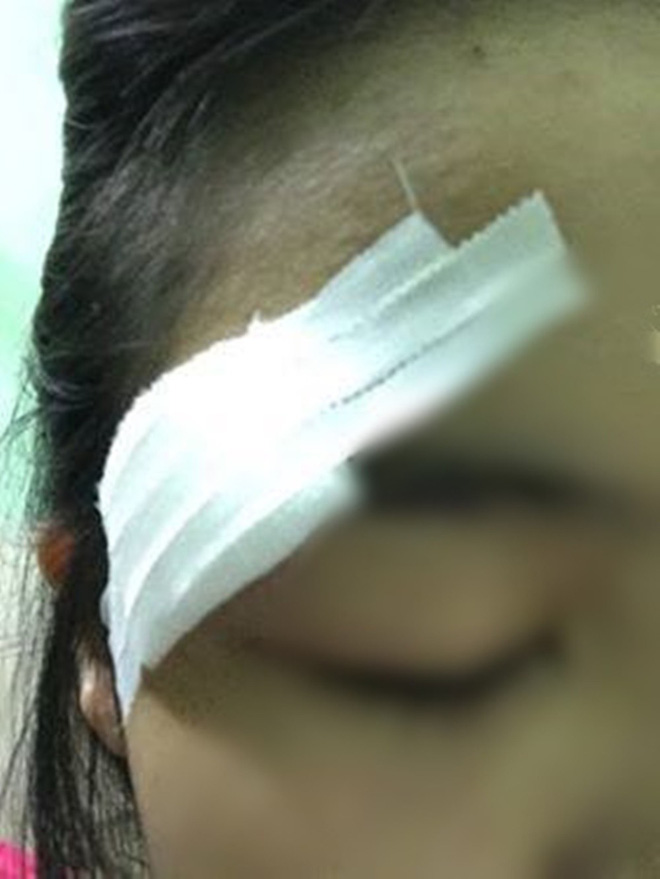 Nữ sinh Sài Gòn bị kẻ biến thái trên xe buýt đuổi đánh rách mí mắt, cha phải đưa đi khâu