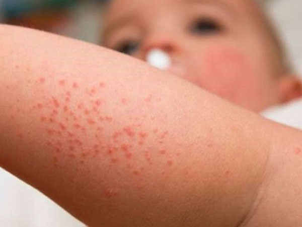 Ca tử vong vì bệnh sởi đầu tiên tại Hà Nội: Chưa đến tuổi tiêm phòng đã mắc bệnh