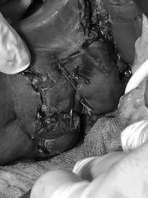 TP.HCM: Thanh niên 18 tuổi bị vỡ gan, dập tá tràng, tràn khí màng phổi nguy kịch sau tai nạn giao thông lúc nửa đêm