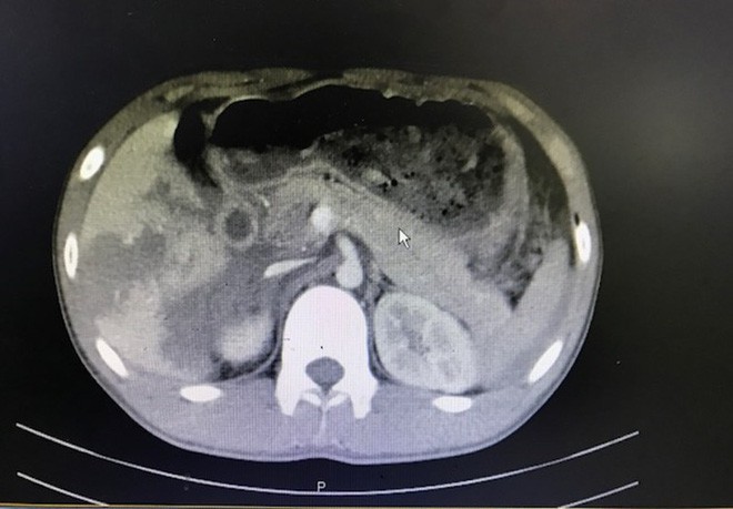 TP.HCM: Thanh niên 18 tuổi bị vỡ gan, dập tá tràng, tràn khí màng phổi nguy kịch sau tai nạn giao thông lúc nửa đêm