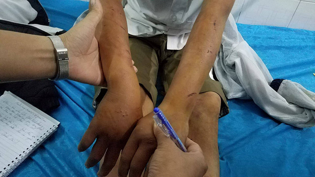 Cậu bé 11 tuổi nghi bị bố đánh đa chấn thương