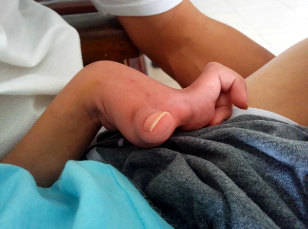 Sau trận sốt cao, bé trai khỏe mạnh thành người tàn phế, bố mẹ khốn khó vì gia cảnh ngặt nghèo