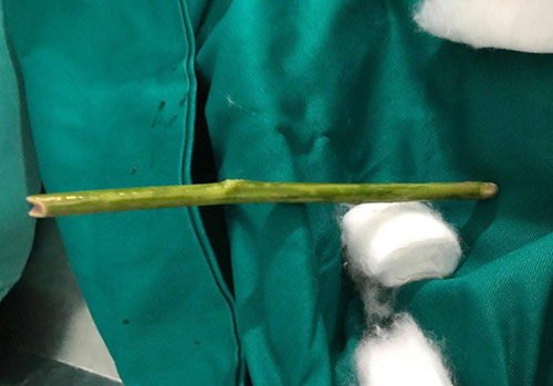 Những cách phá thai không tưởng của giới trẻ