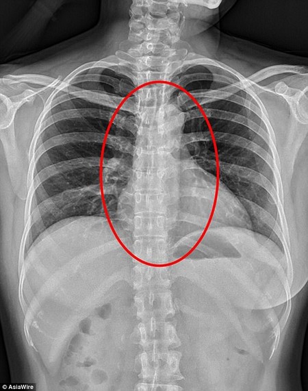 Gái bán dâm nuốt... bao cao su của khách để giấu bằng chứng khi bị cảnh sát bắt