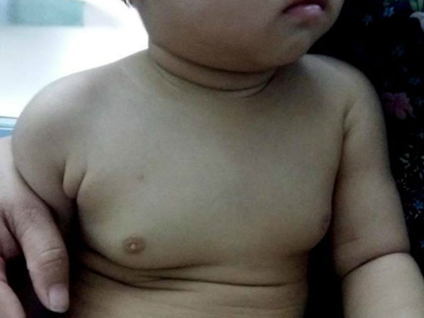 Bé gái 2 tuổi ngực phì đại do thuốc tránh thai từ mẹ