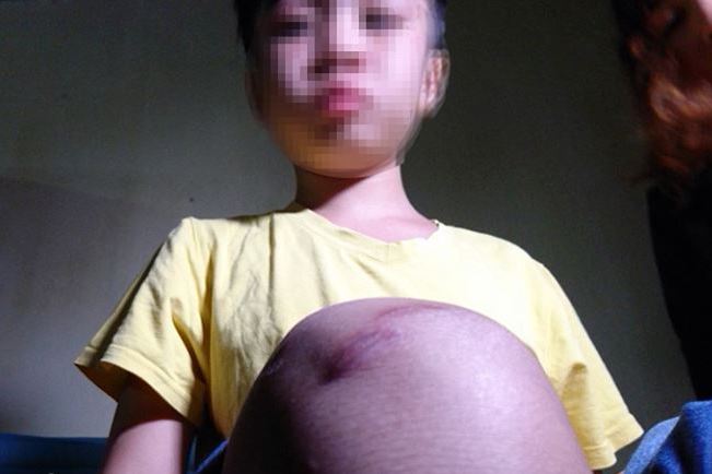 Mẹ kế bạo hành bé 10 tuổi ra công an trình diện