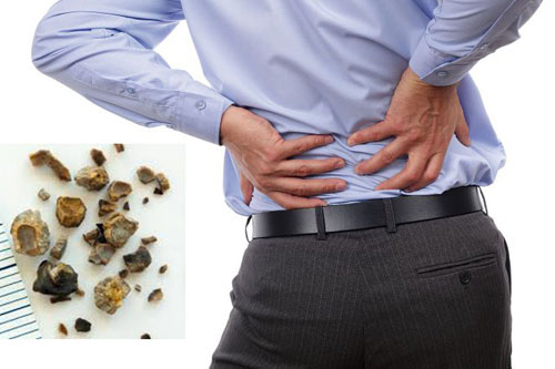 Những ai có nguy cơ mắc sỏi thận? Những ai có nguy cơ mắc sỏi thận?