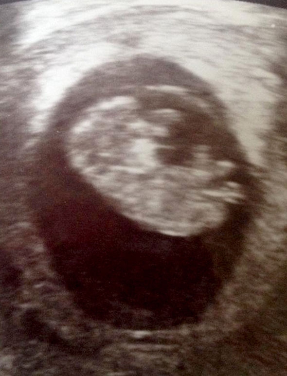 Thai phụ vỡ tử cung, đứa trẻ suýt “chết đuối” trong bụng mẹ vì một biến chứng nguy hiểm