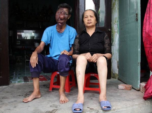 Sóng gió cuộc đời của người đàn ông mang gương mặt quỷ