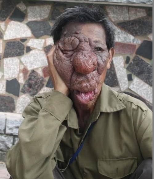 Sóng gió cuộc đời của người đàn ông mang gương mặt quỷ