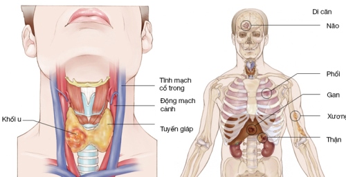 Khối u ung thư cứng như đá trong cổ người đàn ông bị khàn tiếng