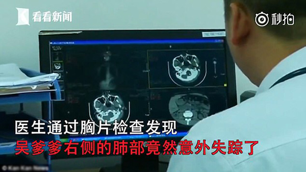 Phổi biến mất sau khi được vợ giác hơi tại nhà