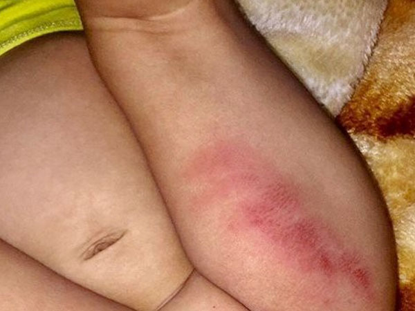 Vụ bé gái bị tím bầm hai đùi: Chủ nhà trẻ nói do… bé gãi