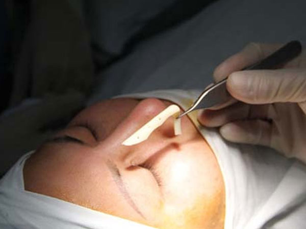 Cô gái bị mù một mắt sau khi tiêm chất nâng mũi