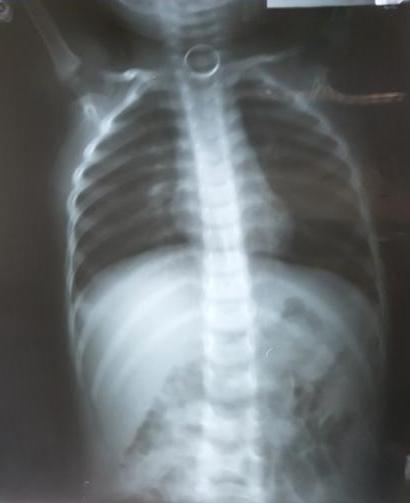 Chiếc móc khóa nằm trong thực quản bé trai hai tuổi