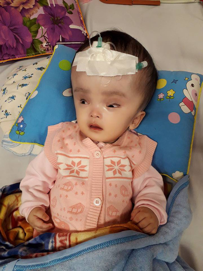 Bé gái 8 tháng tuổi bị não úng thủy đã qua đời