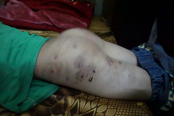 Tôi chỉ đánh con vài vết lằn mông, còn lại cháu bị nhọt