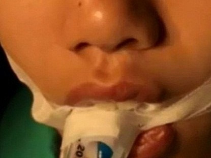 Bé gái suýt chết sau khi được mẹ nặn mụn đầu đen