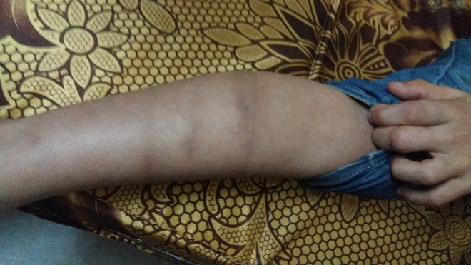 Vụ bé trai trai bị bạo hành ở Đông Anh: Ở trường cháu là học sinh nghịch ngợm