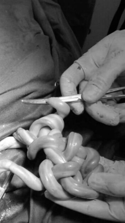 Cặp song sinh Hà Nội chào đời với dây rốn đan vào nhau như tết tóc