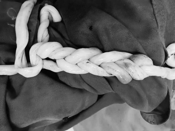 Cặp song sinh Hà Nội chào đời với dây rốn đan vào nhau như tết tóc