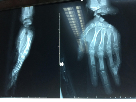 Thiếu niên Sài Gòn bị máy sắt cắt gần lìa bàn tay