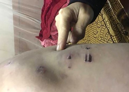 Vụ bé trai 9 tuổi bị bạo hành tại Đông Anh: Bố, mẹ ký đơn hòa giải