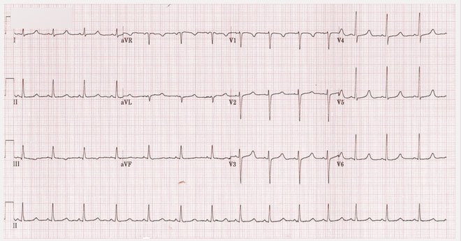8 biểu hiện không ngờ tới của ung thư phổi: Hãy cảnh giác!