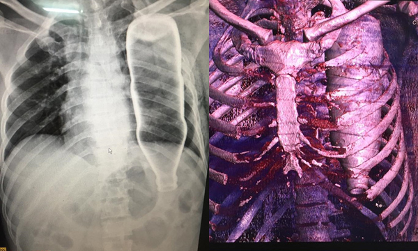 Hy hữu nhất 2017: Bật dậy khi đang lo ma, chai chui tọt lồng ngực