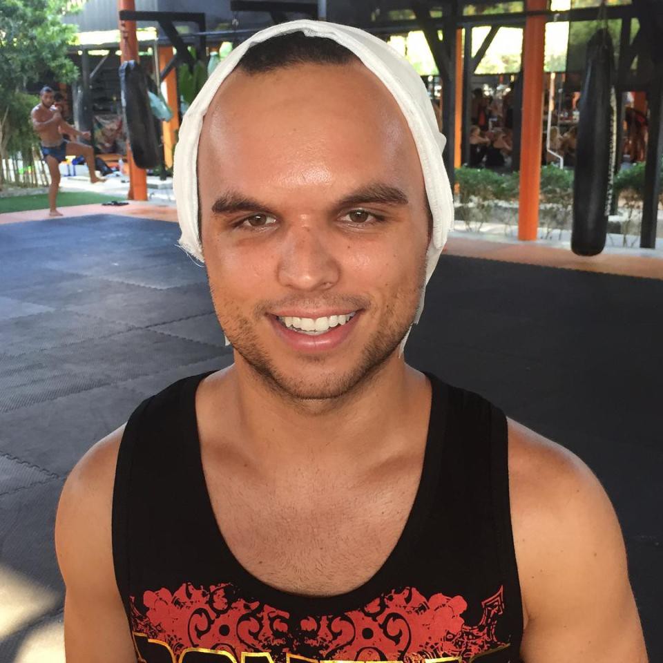 SỐC: Võ sĩ Muay Thái lõm trán kinh hoàng sau cú thúc chỏ của đối thủ