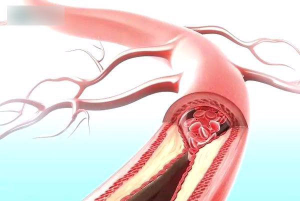 6 hành vi khiến mạch máu tắc nhanh hơn, nhiều người vô tư làm hàng ngày mà không biết