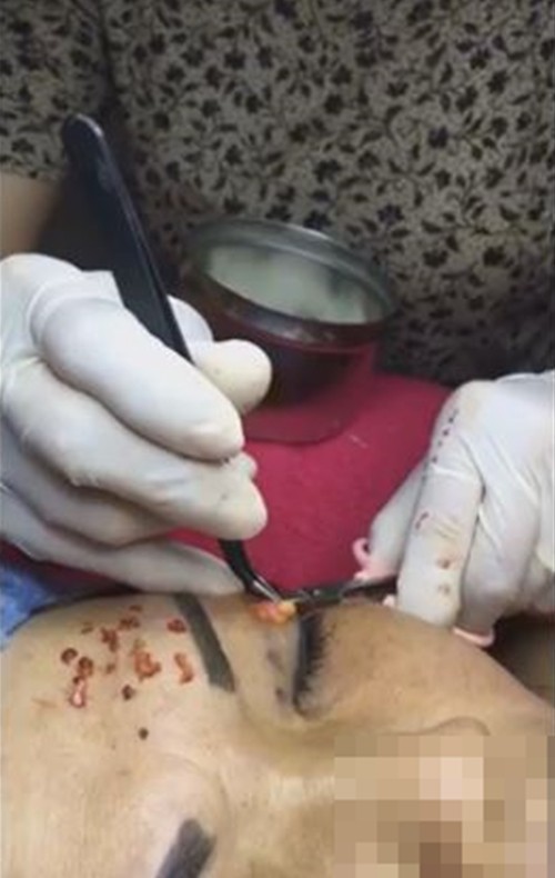 Cô gái mù mắt trái sau khi tiêm filler: Không có bạn trai, tôi đã không gắng gượng được đến lúc này