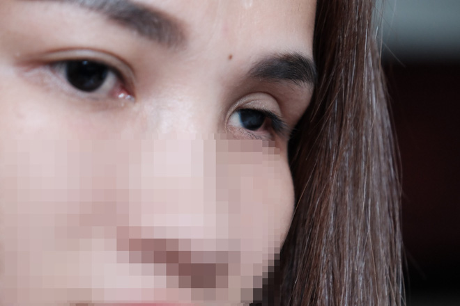 Cô gái mù mắt trái sau khi tiêm filler: Không có bạn trai, tôi đã không gắng gượng được đến lúc này
