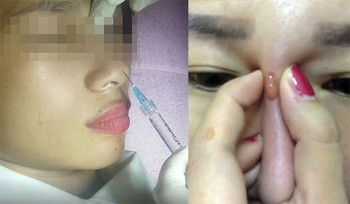 Vì sao tiêm filler nâng mũi lại bị mù mắt?