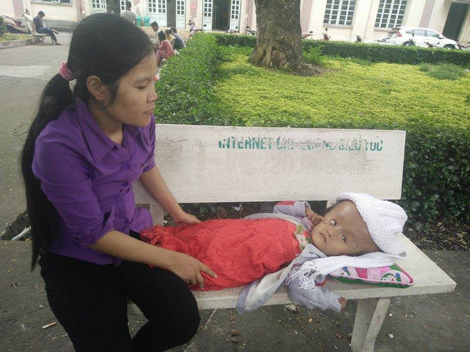 Gần 70 triệu đồng đã giúp bé gái 4 tuổi bị não úng thủy bẩm sinh phẫu thuật thành công, giữ lại mạng sống