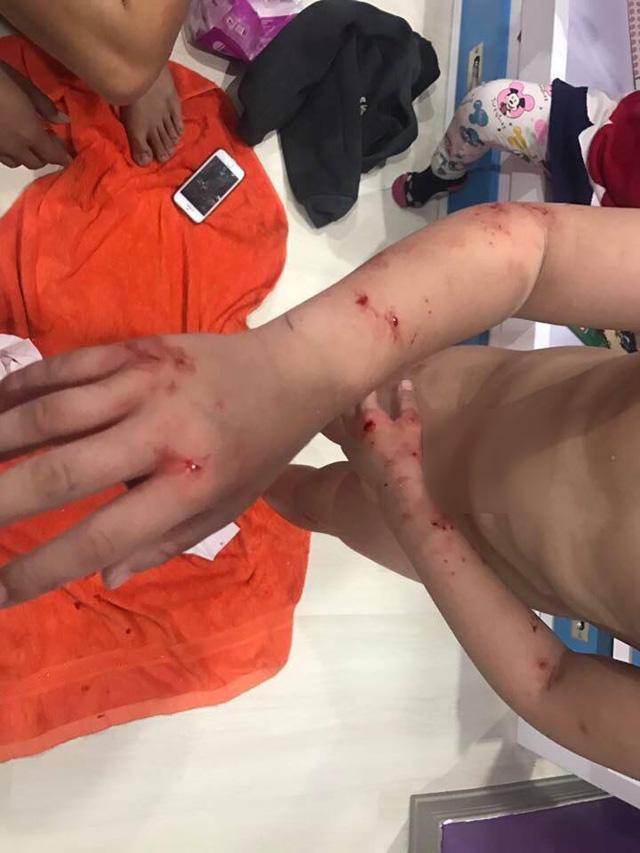 Bé trai 7 tuổi khóc thét khi kính cường lực nhà tắm bỗng dưng phát nổ