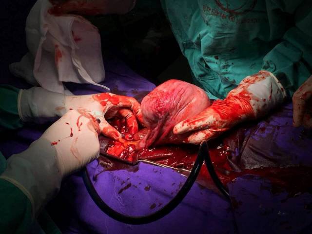 Không theo dõi thai định kỳ, bà mẹ trẻ sốc vì con dị dạng toàn thân, không rõ giới tính