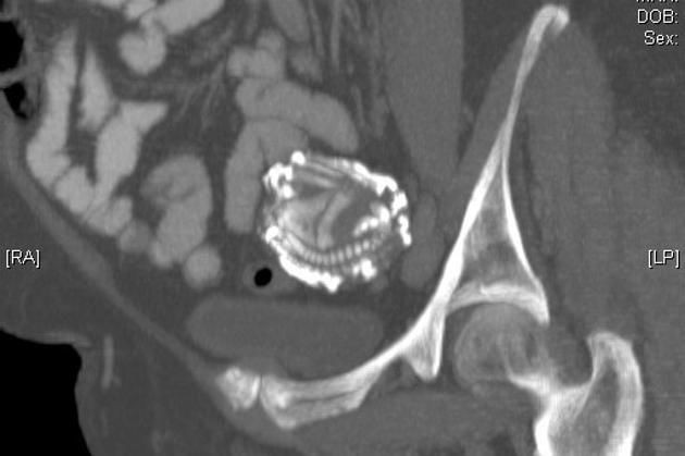 Người phụ nữ mang bầu suốt 46 năm không chịu đẻ, bác sĩ sốc nặng khi lấy bào thai ra