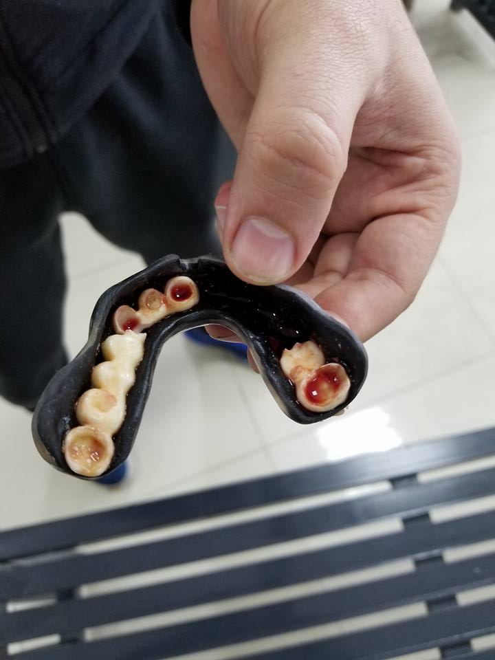 Võ sĩ Trung Quốc bị bay hàm răng vì dùng miếng bảo hộ dỏm Võ sĩ Trung Quốc bị bay hàm răng vì dùng miếng bảo hộ dỏm